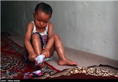 ملیکا دختر پرانرژی و شادابی است و علاقه شدیدی به ظرف شستن و آب بازی دارد زیرا تماس آب به بدنش باعث کمتر شدن سوزش پوست و نرم شدن آن میشود.ملیکاجز ۸نفری است که درکشور مبتلا به این بیماری نادر است