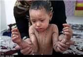 ملیکا دختر 2ساله ایست که  از بدو تولد مبتلا به بیماری ایکتیوز می باشد.این بیماری باعث خشکی سوزش و خارش پوست میشود و ملیکا جزو 8نفری است که درکشور مبتلا به این بیماری نادر است.ایکتیوز جزو بیماریهایی است که درمان آن هزینه بالایی دارد.