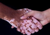 ارائه درمان جدید برای "پیسی" در 2 بیمارستان تهران + جزئیات و هزینه درمان