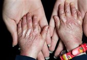 بیماران پروانه‌ای تحت پوشش خدمات رایگان دندانپزشکی قرار می‌گیرند