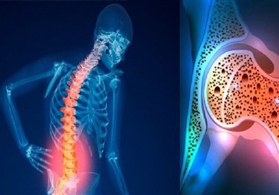 نقش الگوهای غذایی در پیشگیری و کنترل پوکی استخوان