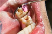 آغاز ارائه خدمات عصب‌کشی با تعرفه دولتی در مراکز منتخب